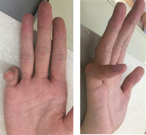 先天性手指屈曲畸形 - 微医（挂号网）