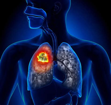 肺癌晚期临终前有哪些症状（肺癌晚期临终前的表现有哪些） - 学堂在线健康网