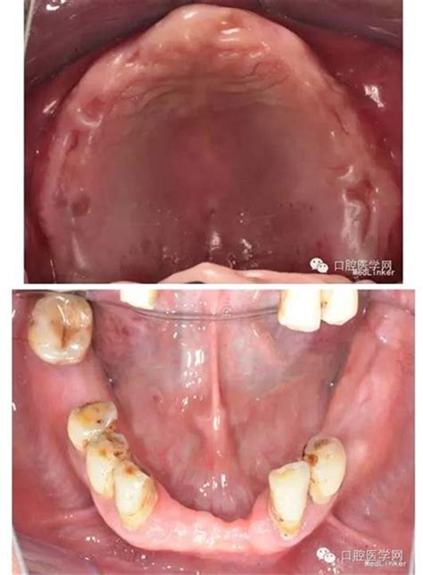 全口杆卡式覆盖义齿修复病例一例-吕昊昕的博客-KQ88口腔博客