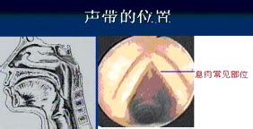 声带图片