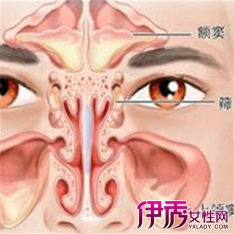 鼻窦炎图片