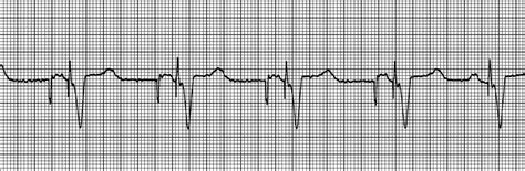 干货丨不同起源室性早搏的心电图表现及定位__凤凰网