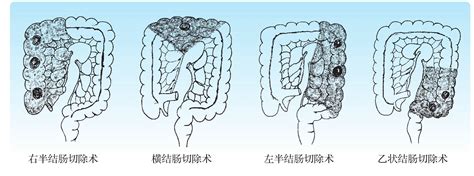 【腹腔镜篇】结直肠癌手术的入路图解 - 新闻动态 - 上海世音光电仪器有限公司