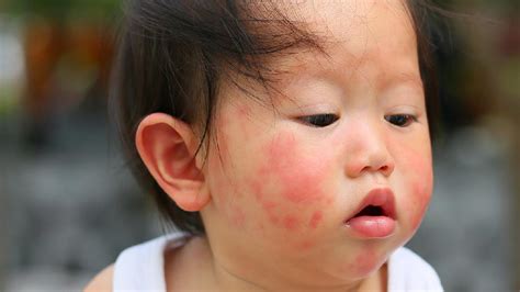 湿疹是如何引起的-湿疹病因-复禾健康
