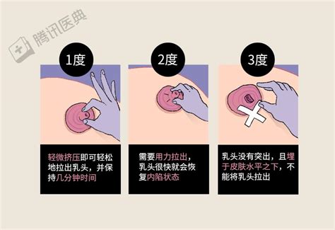 女人乳房下垂收小对以后生育什么的有影响吗_上海美莱整形医院