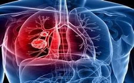 肺癌的组织分型-有来医生