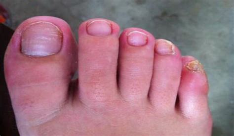 灰指甲的发病原因是什么 如何避免灰指甲传染呢_健康常识_大成皮肤网