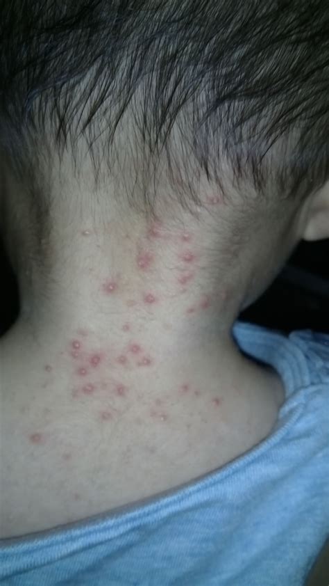 小孩身上出皮疹的图片,荨麻疹图片,脖子上有鼓包图片_大山谷图库