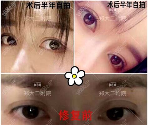 郑州割双眼皮好医生前十名公布,含三甲医院眼修复厉害医生,眼部对比照-8682赴韩整形网