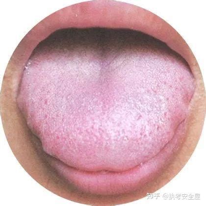 【舌诊大全】120种常见的舌苔超清彩色图谱，建议收藏！ - 知乎