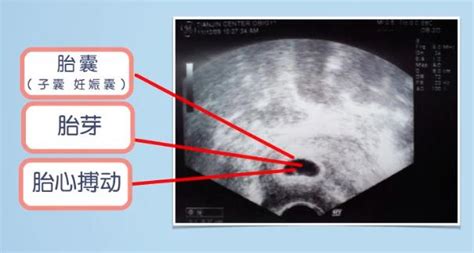 龙凤胎早期孕囊b超图片分享：形状一长一圆也无法准确分辨_家庭医生在线