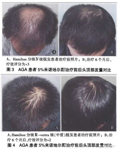 干细胞治疗脱发并促进毛发再生的3大机制-严选细胞