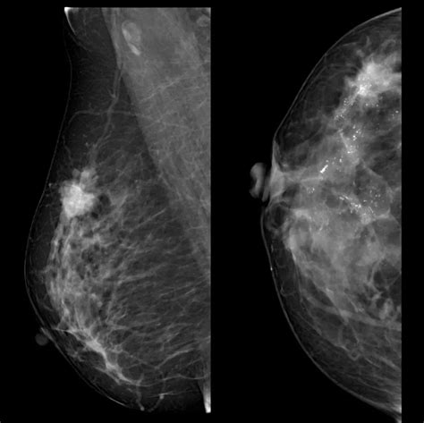 乳腺癌筛查：超声的优势和不足 - 丁香园