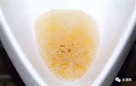 小便黄有泡沫正常吗-尿液发黄又有泡沫是什么原因?