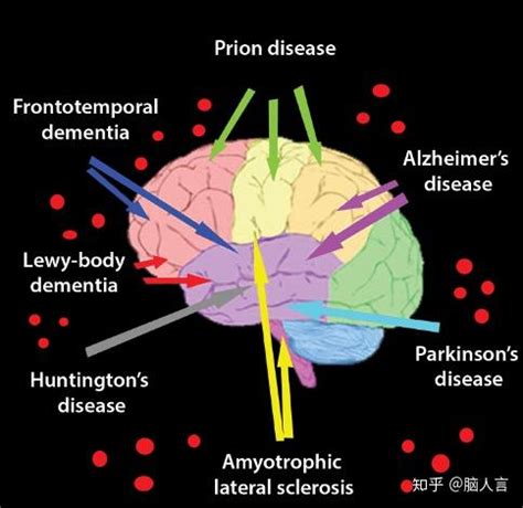 神经退行性疾病伴脑铁沉积症 | 認真不輸 - 醫藥、商企與綜合專題網