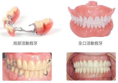 什么是吸附性义齿?根据材料来分有树脂、纯钛义齿...,牙齿修复-8682赴韩整形网