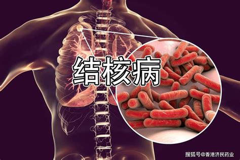 利奈唑胺治疗耐药结核病的适当剂量和持续时间研究_mg_方案_贝达