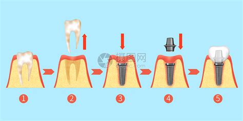 牙齿种植牙治疗过程步骤医疗插画插画图片下载-正版图片401804272-摄图网