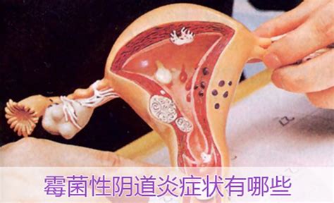 女性阴道炎症状女人妇科干涩疼用什么药2022已更新今日图集