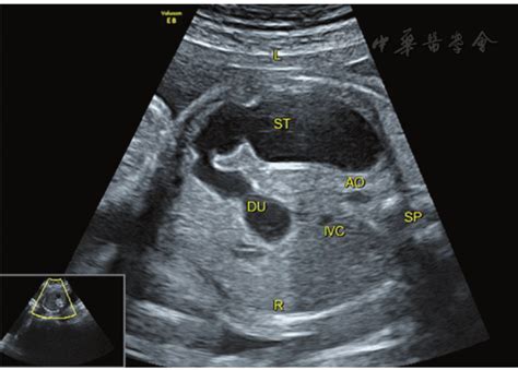胎儿肺动脉吊带超声表现1例_经典病例_医脉通