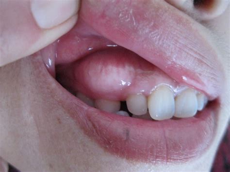牙疼的牙龈肿了个鼓包怎么回事?教你们如何预防牙齿肿痛五个妙招_之美网