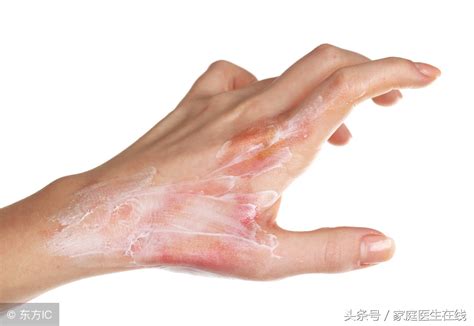 皮肤烫伤怎么处理（皮肤科医生：不小心被烫伤，这7个处理方法要谨记） | 说明书网