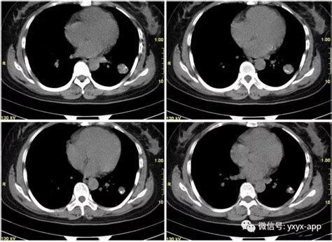 肺部点状钙化影是什么意思肺部点状钙化灶肺部点状结节肺部点状致密影