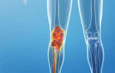 膝盖疼痛伸直痛是什么原因？ - 健康知识 - 轻壹
