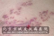 带状疱疹发病时的症状有哪些_带状疱疹_北京京城皮肤医院(北京医保定点机构)