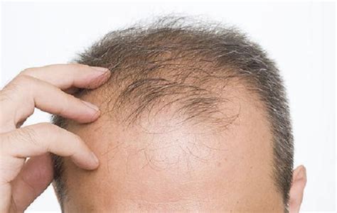 秃顶植发手术后可以达到什么样的效果-发友网