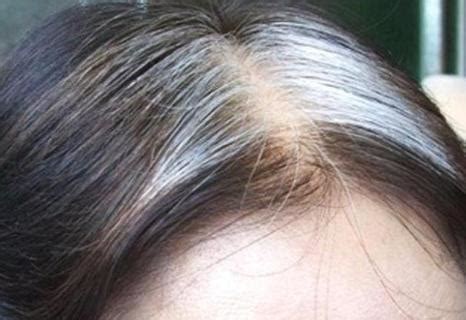 前额长白发的根源到底在哪里？分享治疗白发的方法超简单 - 知乎