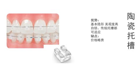 牙齿矫正的详细流程以及矫正器种类的介绍