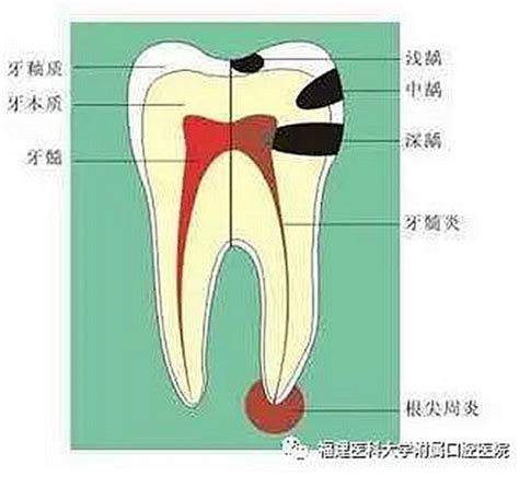 【口腔科普】牙髓炎的症状有哪些？ 科贸嘉友收录|牙医解答|陕西嘉友科贸有限公司