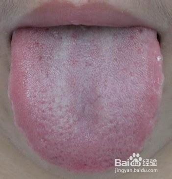 湿热舌苔图片