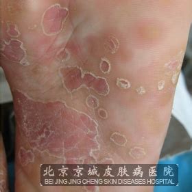 二期梅毒图片