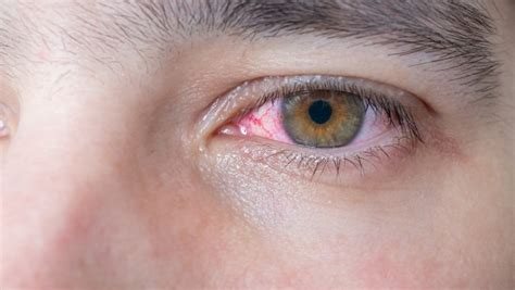 红眼病是怎么进行传染的 红眼病应如何预防-红眼病概况-复禾健康