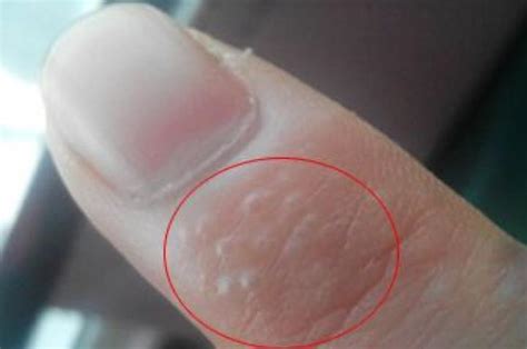 【小水泡】【图】手上长小水泡的原因有哪些 盘点手上水泡的特征_伊秀健康|yxlady.com