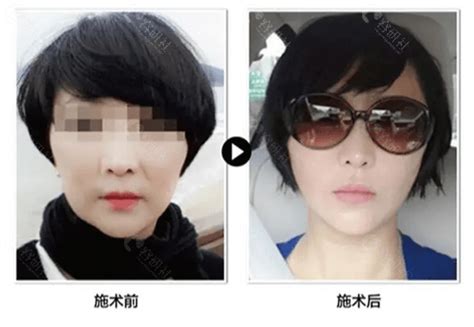 韩国GNG济颜吉整形医院隆鼻，鼻修复手术有什么特色？（附真人对比案例） - 爱美容研社