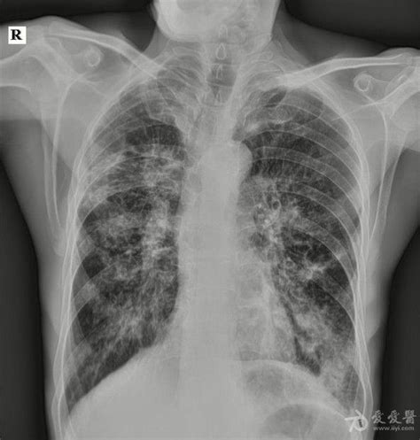 肺部X线病变的7种征象，不可不学