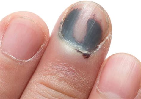 黑指甲是什么症状图片及预防