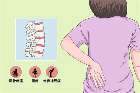 腰间盘突出图片