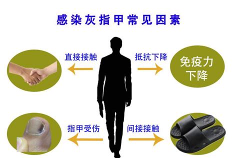 得了灰指甲，一个传染俩，这5种人最容易得灰指甲-北京安达医院