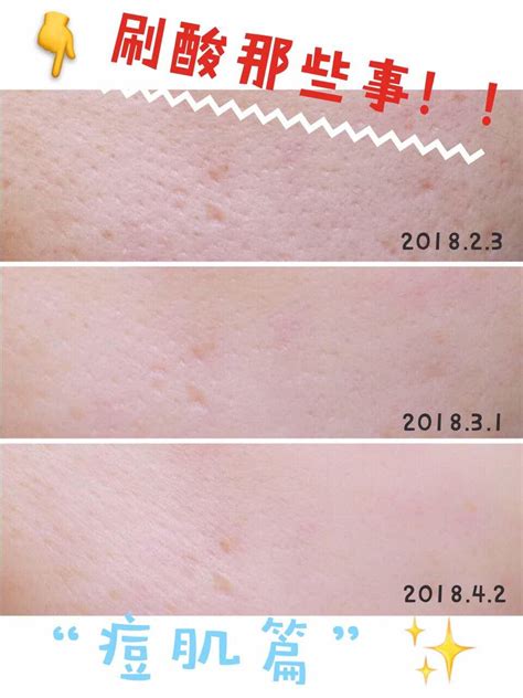 水杨酸会有令皮肤变敏感的危险吗？