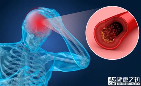 脑血栓和脑梗的区别及前兆表现和发病原因,怎么治疗吃什么好