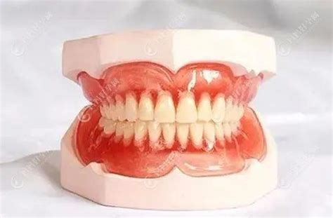 bps吸附性义齿价格贵吗?与普通活动义齿的区别有谁知道 - 口腔资讯 - 牙齿矫正网