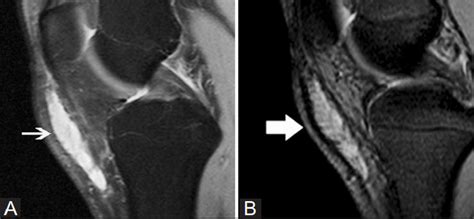 磁共振成像MRI膝盖后部角中枢断裂的眼泪高清图片下载-正版图片505945942-摄图网