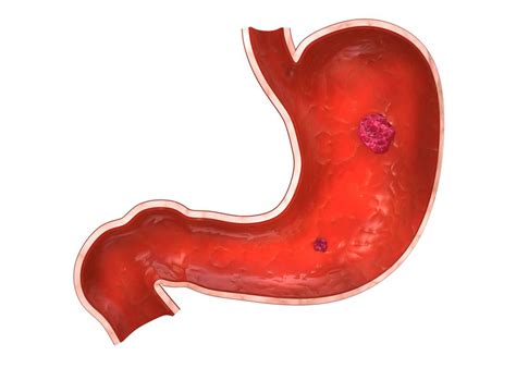 胃酸过多是什么情况？这几种原因会导致胃酸过多 - 知乎