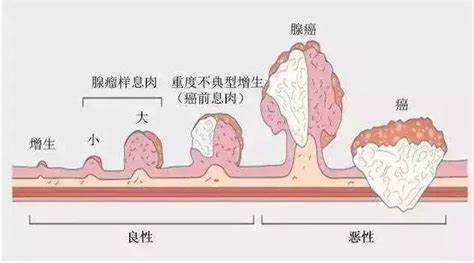 痔疮什么样的图片