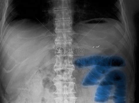 腹部X线小肠梗阻高清图片下载-正版图片501819627-摄图网