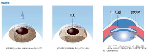 ICL晶体植入前房深度要求是怎样的？-合肥沃瑞眼科医院官网